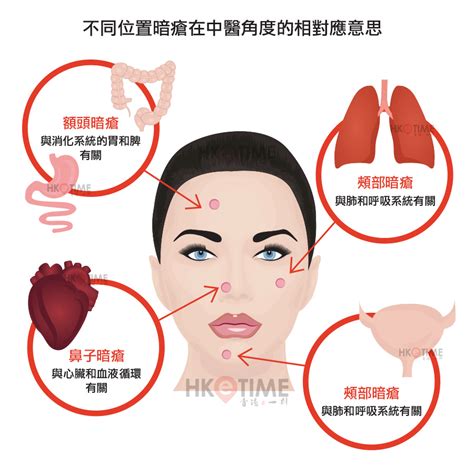 面部生瘡|【暗瘡位置】不同代表什麼？中醫教如何處理及預防